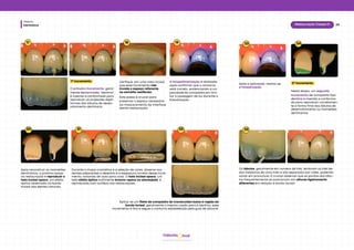 Dentística
Módulo
28
Restauração Classe IV
hud
Odonto
20 21 22
Após reconstruir os mamelões
dentinários, o próximo passo
na restauração é reproduzir o
halo incisal opaco, um efeito
óptico observado na borda
incisal dos dentes naturais.
Durante o mapa cromático e a seleção de cores, observe nos
dentes adjacentes o desenho e a espessura correta desse incre-
mento, variando de caso para caso. O halo incisal opaco, um
belo efeito óptico sutilmente branco-opaco ou alaranjado, é
reproduzido com sutileza nas restaurações.
Aplica-se um filete de compósito de translucidez baixa à região da
borda incisal, geralmente o mesmo usado para a dentina, esse
incremento é fino e segue o contorno estabelecido pela guia de silicone.
17 18 19
1º incremento
O primeiro incremento, geral-
mente denominado “dentina”,
é inserido e conformado para
reproduzir as projeções digiti-
formes dos lóbulos de desen-
volvimento dentinário.
Verifique, em uma vista incisal,
que esse incremento não
invade o espaço referente
ao esmalte vestibular.
Este passo é crucial para
preservar o espaço necessário
ao mascaramento da interface
dente-restauração.
A fotopolimerização é realizada
após confirmar que o contorno
está correto, evidenciando a ca-
pacidade do compósito em limi-
tar a passagem de luz durante a
fotoativação.
23 24
Após a aplicação, realiza-se
a fotoativação.
2º incremento
Nesta etapa, um segundo
incremento de compósito tipo
dentina é inserido e conforma-
do para reproduzir corretamen-
te a forma final dos lóbulos de
desenvolvimento ou mamelões
dentinários.
25
Os lóbulos, geralmente em número de três, lembram os três de-
dos medianos de uma mão e são separados por vales, podendo
variar em pronúncia. É crucial observar que as pontas dos lóbu-
los frequentemente se posicionam em alturas ligeiramente
diferentes em relação à borda incisal.
 