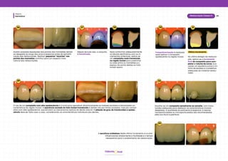 Dentística
Módulo
29
Restauração Classe IV
hud
Odonto
26
29
27 28
Avaliar possíveis exposições das pontas dos mamelões devido
ao desgaste ao longo dos anos é essencial antes da estratifi-
cação das restaurações. Realizar pequenos “recortes” nas
pontas dos mamelões contribui para um aspecto mais
natural das restaurações.
Depois de tudo isso, o conjunto
é fotoativado.
O uso de um compósito com alta opalescência é crucial para reproduzir dinamicamente os matizes azulados e alaranjados ca-
racterísticos da região incisal. A aparência azulada do halo incisal translúcido é obtida não por tintas azuladas, mas por compó-
sitos com alta opalescência, que emulam os mecanismos ópticos do dente natural. A seleção do grau de translucidez e opales-
cência deve ser feita caso a caso, considerando as características individuais dos dentes.
Após conformar adequadamente
os lóbulos dentinários com os in-
crementos anteriores, aplica-se
um compósito mais translúcido
na região incisal para preencher
os vales entre os mamelões e o
espaço da ponta destes ao halo
incisal opaco.
30 31
Fotopolimerização é realizada
após aplicar o compósito
opalescente na região incisal.
Último incremento
No último estágio da restaura-
ção, aplica-se o incremento
final de compósito para com-
pletar o volume da coroa, bus-
cando um equilíbrio entre o mí-
nimo de excesso e a presença
adequada do material restau-
rador.
32
Escolhe-se um compósito semelhante ao esmalte, com trans-
lucidez adequada para destacar as características incisais
desejadas. A qualidade do polimento é essencial, e resinas
nanoparticuladas ou microparticuladas são recomendadas
pela sua lisura superficial.
33
A escultura cuidadosa deste último incremento é crucial,
influenciando diretamente a facilidade e o tempo
necessários para o acabamento da restauração.
 
