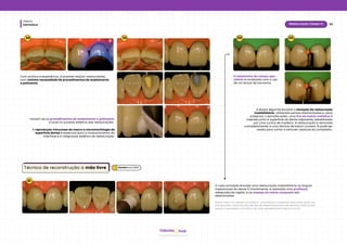 Dentística
Módulo
30
Restauração Classe IV
hud
Odonto
34 35
Com prática e experiência, é possível realizar restaurações
com mínima necessidade de procedimentos de acabamento
e polimento.
Iniciam-se os procedimentos de acabamento e polimento,
crucial no sucesso estético das restaurações.
A reprodução minuciosa da macro e micromorfologia da
superfície dental é essencial para o mascaramento da
interface e a integração estética da restauração.
01
Técnica de reconstrução à mão livre
O caso simulado envolve uma restauração insatisfatória no ângulo
mesioincisal do dente 11.Inicialmente, é realizada uma profilaxia
adequada da região, e as massas de resina composta são
selecionadas.
Assim como na sequência anterior, a avaliação cuidadosa das cores, graus de
translucidez, contorno dos lóbulos de desenvolvimento da dentina, halo incisal
opaco e expressão cromática da área opalescente incisal é crucial.
02 03
O isolamento do campo ope-
ratório é conduzido com o uso
de um lençol de borracha.
A etapa seguinte envolve a remoção da restauração
insatisfatória, utilizando pontas diamantadas e, para
preservar o esmalte sadio, uma tira de matriz metálica é
inserida junto à superfície do dente adjacente, estabilizada
por uma cunha de madeira. A restauração é removida
completamente, e uma lâmina de bisturi número 12 pode ser
usada para cortar e remover resíduos do compósito.
Baratieriet al. (2010)
 