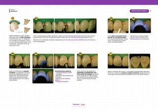 Dentística
Módulo
31
Restauração Classe IV
hud
Odonto
04 05
Nesta sequência, opta-se pela
execução de um bisel vestibular,
caracterizado por um desgaste
nas margens do preparo cavitá-
rio, com aproximadamente 2 mm
e extensão, podendo variar de
caso para caso.
Com a restauração antiga removida, utilizou-se uma ponta diamantada em forma de chama,
posicionada a 45° com a superfície dental, para criar um bisel de aproximadamente 2 mm.
06 07 08
Após a finalização do preparo
cavitário, a superfície é limpa e
os dentes adjacentes são pro-
tegidos do condicionamento
ácido e da aplicação do sis-
tema adesivo por uma matriz
de poliéster.
Procedimentos adesivos:
- Condicionamento ácido.
- Lavagem.
- Remoção dos excessos de
umidade.
- Aplicação do sistema
adesivo.
- Fotopolimerização.
Uma nova tira de poliéster é
adaptada e estabilizada com
uma cunha de madeira, servindo
como base para a delimitação
dos contornos da restauração e
para a conformação da face
palatal.
Observa-se a proteção do dente adjacente com uma tira de matriz metálica para minimizar o
risco de desgaste.
09 10
Uma resina composta micro-
híbrida ou nanoparticulada,
com boas propriedades mecâ-
nicas, é inserida para repro-
duzir o esmalte palatal.
Mantendo a pressão digital
sobre a matriz, realiza-se a
fotoativação do incremento.
11
Após a remoção da matriz, o compósito polimerizado reproduz
de forma próxima o contorno original do dente, destacando-se
o alto grau de translucidez compatível com o esmalte natural.
 