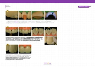 Dentística
Módulo
33
Restauração Classe IV
hud
Odonto
20
21
Na mesma sessão da realização da restauração, os procedimentos de acabamento inicial
são realizados. A atenção especial é dada ao ajuste oclusal, devido à possibilidade de con-
tatos prematuros em restaurações com conformação palatal feita à mão livre. Em uma
sessão clínica subsequente, concluem-se o acabamento e o polimento da restauração.
O compósito escolhido, com características ópticas de esmalte e excelente capacidade de polimento, é esculpido
meticulosamente com pincéis. Pequenos excessos de material restaurador são deixados intencionalmente, considerando
os desgastes que ocorrerão durante o acabamento.
22
Essas etapas visam conferir à restauração características
semelhantes ao remanescente dental e aos dentes adjacentes
(lisura, macro e micromorfologia), restaurando a harmonia
visual nos dentes anteriores. O resultado final é esteticamente
agradável, com uma integração notável de forma e cor entre
o material restaurador e a estrutura dental.
 