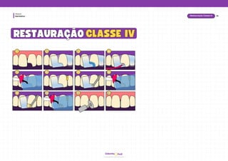 hud
Odonto
Dentística
Módulo
1
1 2
2 3
3 4
4
5
5 6
6 7
7 8
8
9
9 10
10 11
11 12
12
CLASSE IV
CLASSE IV
RESTAURAÇÃO
RESTAURAÇÃO
34
Restauração Classe IV
 
