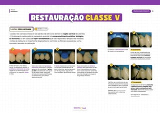 hud
Odonto
Dentística
Módulo
35
Restauração Classe V
RESTAURAÇÃO
RESTAURAÇÃO CLASSE V
CLASSE V
Lesões não cariosas
1 2 3 4
• Lesões não cariosas Classe V são perdas de estrutura dental na região cervical dos dentes.
• O tratamento restaurador é necessário quando há comprometimento estético, biológico
ou funcional, ou em casos de hiper-sensibilidade que não responde a terapia não invasiva.
• Antes de restaurar, é importante diagnosticar e controlar os fatores causadores, como
corrosão, abrasão ou abfração.
Antes de fazer uma restau-
ração, é necessário realizar a
profilaxia, selecionar as cores,
registrar as informações cro-
máticas e, em seguida, isolar
a área.
Isola-se a área com grampos
retratores, expondo a margem
gengival da cavidade. O gram-
po 212 é estabilizado com godi-
va de baixa fusão, aplicada
através de cones plastificados
na lamparina, para evitar
deslocamentos.
O ácido é aplicado começando
no esmalte e estendendo-se
para a dentina, permanecendo
por 15 segundos, seguido de
uma lavagem igualmente longa.
Duas camadas do sistema
adesivo são aplicadas na den-
tina, intercaladas com jatos
de ar para evaporar solventes,
removendo os excessos de ade-
sivo nas margens e na garra
do grampo retrator.
O adesivo é fotoativado antes
de inserir os compósitos.
Inicia-se com a aplicação de
um incremento de compósito
levemente saturado contra a
margem cervical da cavidade,
utilizando espátulas e pincéis.
1º incremento
5 6
Verifica﻿
-se o contorno da res-
tauração para eliminar exces-
sos e assegurar que o volume
preenchido seja apropriado.
Realiza-se a fotoativação
de acordo com a técnica
selecionada.
O ﻿
segundo incremento preenche
o espaço entre a margem oclu-
sal e a resina composta já poli-
merizada, deixando espaço para
um último incremento.
Em seguida, é realizada a
fotoativação.
2º incremento
7 8
Baratieriet al. (2010)
 