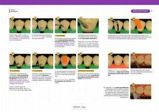 hud
Odonto
Dentística
Módulo
37
Restauração Classe V
5 6 7 8
9 10 11 12
Após﻿15 segundos, o ácido é
lavado, a dentina é protegida
com algodão e o esmalte é se-
co com jatos de ar.
O sistema adesivo é aplicado
e fotoativado após a volatiza-
ção dos solventes. No primeiro incremento, resina
com características ópticas
similares à dentina é aplicada
nas paredes gengival e axial
da cavidade, evitando o espa-
ço do esmalte.
Certifique﻿
-se de preencher
completamente a área de es-
malte sem apoio dentinário.
Feito isso, o primeiro incremen-
to é fotoativado por um curto
período para reduzir o estresse
de contração de polimerização.
1º incremento
O segundo incremento de
compósito, com característi-
cas ópticas semelhantes às
da dentina, é aplicado em
direção às paredes oclusal e
axial da cavidade, sem invadir
o espaço de esmalte.
Após a conformação do
segundo incremento, ele é foto-
ativado por cerca de 5 segundos.
O último incremento do mes-
mo compósito (dentina) é
aplicado no centro da cavida-
de para preencher o espaço
restante referente à dentina.
O uso de pincéis é recomenda-
do para suavizar as transições
entre os incrementos dentiná-
rios.
A fotopolimerização final dos
incrementos de dentina é rea-
lizada.
2º incremento 3º incremento
Após a reconstrução da dentina,
os compósitos com característi-
cas ópticas semelhantes ao es-
malte são inseridos.
Incremento de esmalte
13 14
A aplicação e a conformação dos compósitos são feitas com
espátulas e pincéis, visando obter uma superfície final mais lisa e
um contorno semelhante ao desejado para a restauração.
15 16
Após a fotoativação final do
compósito, o dique de borracha
e o grampo retrator são removi-
dos.
Discos﻿abrasivos são usados
em uma sequência decrescente
de abrasividade.
Em seguida, uma pasta de polimento
é aplicada com um disco de feltro
para conferir alto brilho à superfície
da restauração. Após esses proce-
dimentos, a restauração apresenta
resultados funcional e esteticamente
satisfatórios.
17
 