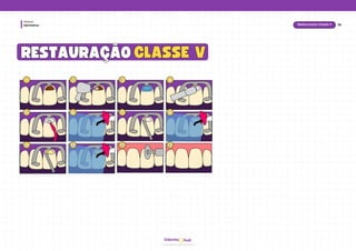 hud
Odonto
Dentística
Módulo
1
1 2
2 3
3 4
4
5
5 6
6 7
7 8
8
9
9 10
10 11
11 12
12
CLASSE V
CLASSE V
RESTAURAÇÃO
RESTAURAÇÃO
38
Restauração Classe V
 