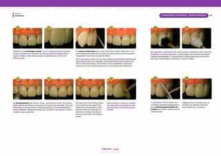 hud
Odonto
Dentística
Módulo
40
Acabamento e Polimento - Dentes anteriores
12 13 14 15
16 17 18 19
Os sulcos horizontais são mais profundos e bem definidos, com
uma disposição semicircular que se origina de um ponto central
imaginário na borda incisal do dente.
As periquimácias são sulcos rasos, numerosos e sutis, formados
pelas estrias de Retzius durante a formação do esmalte. Elas são
simuladas criando várias linhas paralelas com pontas diaman-
tadas afiladas, idealmente sem se cruzarem. Isso ajuda a recriar
a textura da superfície.
Isso permite uma restauração
com a textura da superfície
vestibular semelhante à dos
dentes naturais. Eles são es-
senciais na etapa de texturi-
zação e polimento da restau-
ração.
Detalhes da morfologia incisal, como irregularidades e deltas
incisais, podem ser criados com pontas diamantadas de pe-
queno calibre. Essa etapa ajuda a aperfeiçoar a forma da
restauração.
Para reproduzir esses sulcos, são usadas pontas diamantadas de
granulação fina com pressão controlada para evitar que se tor-
nem muito profundos. Se ficarem muito evidentes, é possível
suavizá-los com pastas abrasivas ou borrachas de polimento.
Para suavizar a textura, podem
ser utilizadas borrachas ou dis-
cos flexíveis com baixa abrasi-
vidade.
20 21
Em seguida, o polimento da restauração é realizado com escovas
Robinson ou discos de feltro, combinados com pastas de abrasi-
vidade decrescente. É fundamental utilizar escovas e discos lim-
pos para cada pasta, evitando a mistura delas.
22 23
O polimento é finalizado com
um disco de feltro associado a
uma pasta de granulação ex-
trafina para dar o brilho final à
restauração.
Aspecto final, tentativa de re-
produzir os dentes naturais
executada com sucesso.
 