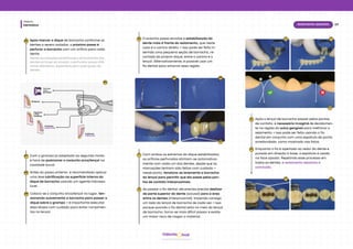 Dentística
Módulo
07
Isolamento absoluto
hud
Odonto
06
Dentes
com
grampo
Incisivos
superiores
Incisivos
inferiores
Molares
Caninos
e Pré-
molares
06
Após marcar o dique de borracha conforme os
dentes a serem isolados, o próximo passo é
perfurar a borracha com um orifício para cada
dente.
Devido às variações anatômicas e dimensionais dos
dentes ao longo da arcada, o perfurador possui dife-
rentes diâmetros, específicos para cada grupo de
dentes.
Com o grampo já adaptado ao segundo molar,
é hora de posicionar o conjunto arco/lençol na
cavidade bucal.
Antes do passo anterior, é recomendado aplicar
uma leve lubrificação na superfície interna do
dique de borracha usando um agente hidrosso-
lúvel.
07
08
Coloca-se o conjunto arco/lençol no lugar, ten-
sionando suavemente a borracha para passar o
dique sobre o grampo → é importante executar
essa etapa com cuidado para evitar rompimen-
tos no lençol.
09
O próximo passo envolve a estabilização do
dente mais à frente do isolamento, que neste
caso é o canino direito → isso pode ser feito in-
serindo uma pequena seção de borracha, re-
cortada do próprio dique, entre o canino e o
lençol. Alternativamente, é possível usar um
fio dental para amarrar essa região.
10
07 08
09 10
Com ambos os extremos do dique estabilizados,
os orifícios perfurados alinham-se automatica-
mente com cada um dos dentes, desde que as
marcações tenham sido feitas com cuidado →
nesse ponto, tensiona-se levemente a borracha
do lençol para permitir que ela passe pelos pon-
tos de contato interproximais.
11
Ao passar o fio dental, ele precisa precisa deslizar
da parte superior do dente (oclusal) para a área
entre os dentes (interproximal), trazendo consigo
um lado do lençol de borracha de cada vez → isso
porque quando o fio dental está no meio do lençol
de borracha, torna-se mais difícil passar e existe
um maior risco de rasgar o material.
12
11 11
12
13 14
Após o lençol de borracha passar pelos pontos
de contato, é necessário invaginá-lo devidamen-
te na região do sulco gengival para melhorar o
selamento → isso pode ser feito usando o fio
dental em conjunto com uma espátula de ponta
arredondada, como mostrado nas fotos.
13
Enquanto o fio é apertado ao redor do dente e
puxado em direção à base, a espátula é usada
na face oposta. Repetindo esse processo em
todos os dentes, o isolamento absoluto é
concluído.
14
 