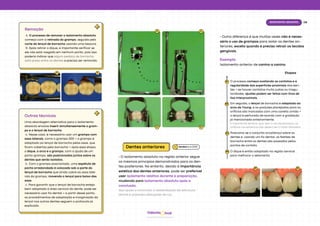 08
Isolamento absoluto
hud
Odonto
A
Remoção
A. O processo de remover o isolamento absoluto
começa com a retirada do grampo, seguida pelo
corte do lençol de borracha usando uma tesoura.
B. Após retirar o dique, é importante verificar se
ele não está rasgado em nenhum ponto, pois isso
poderia indicar que algum pedaço de borracha
está preso entre os dentes e precisa ser removido.
A
Outras técnicas
Uma abordagem alternativa para o isolamento
absoluto envolve inserir simultaneamente o gram-
po e o lençol de borracha.
a. Nesse caso, é necessário usar um grampo com
asas laterais, como o grampo 200 → o grampo é
adaptado ao lençol de borracha pelas asas, que
ficam cobertas pela borracha → após essa etapa,
o dique, o arco e o grampo, com a ajuda de um
porta-grampo, são posicionados juntos sobre os
dentes que serão isolados.
b. Com o grampo posicionado, uma espátula de
ponta arredondada é colocada sob a parte do
lençol de borracha que ainda cobre as asas late-
rais do grampo, movendo o lençol para baixo das
asas.
c. Para garantir que o lençol de borracha esteja
bem adaptado à área cervical do dente, pode ser
necessário usar fio dental → a partir desse ponto,
os procedimentos de adaptação e invaginação do
lençol nos outros dentes seguem o protocolo já
explicado.
a b
a a
Dentes anteriores
• O isolamento absoluto na região anterior segue
os mesmos princípios demonstrados para os den-
tes posteriores. No entanto, devido à importância
estética dos dentes anteriores, pode ser preferível
usar isolamento relativo durante a preparação,
mudando para isolamento absoluto após a
conclusão.
Isso ajuda a minimizar a desidratação da estrutura
dental e possíveis alterações de cor.
• Outra diferença é que muitas vezes não é neces-
sário o uso de grampos para isolar os dentes an-
teriores, exceto quando é preciso retrair os tecidos
gengivais.
Exemplo
Isolamento anterior de canino a canino.
O processo começa avaliando os contatos e a
regularidade das superfícies proximais dos den-
tes → se houver contatos muito justos ou irregu-
laridades, ajustes podem ser feitos com tiras de
lixa interproximais.
01
02
Etapas
Em seguida, o lençol de borracha é adaptado ao
arco de Young, e as posições planejadas para os
orifícios são marcadas com uma caneta úmida →
o lençol é perfurado de acordo com a gradação
já mencionada anteriormente.
É importante lembrar que, sem o uso de grampos, os
orifícios nos extremos não devem ter o maior diâmetro.
Posiciona-se o conjunto arco/lençol sobre os
dentes e, usando um fio dental, os festões de
borracha entre os dentes são passados pelos
pontos de contato.
O dique é então adaptado na região cervical
para melhorar o selamento.
03
04
01 01
Baratieriet al. (2010)
 
