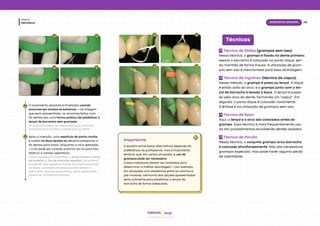 Dentística
Módulo
09
Isolamento absoluto
hud
Odonto
02 02
03 04
O isolamento absoluto é finalizado usando
amarrias em ambos os extremos → na imagem
que será apresentada, as amarrias feitas com
fio dental são uma forma prática de estabilizar o
lençol de borracha sem grampos.
As amarrias podem ser preparadas com nós extra-
oralmente para facilitar a adaptação ao dente.
05
Após a inserção, uma espátula de ponta romba
é usada na face oposta ao nó para pressionar o
fio dental para baixo, enquanto o nó é apertado
→ o fio pode ser cortado próximo ao nó para não
obstruir o campo operatório.
Outras opções para estabilizar o lençol incluem cunhas
de madeira ou fios de borracha especiais. No entanto,
é sugerido usar pequenas seções da própria borracha
do dique, recortadas de áreas que não afetem o
isolamento. Quando tensionadas, essas seções finas
podem ser facilmente inseridas.
06
Importante
A escolha entre essas alternativas depende da
preferência do profissional, mas é importante
lembrar que, em certas situações, o uso de
grampos pode ser necessário.
Casos individuais devem ser avaliados para
determinar a melhor abordagem → por exemplo,
em situações com diastemas entre os caninos e
pré-molares, nenhuma das opções apresentadas
seria suficiente para estabilizar o lençol de
borracha de forma adequada.
05
06
06
05 05
06
Técnicas
Técnica de Stibbs (grampos sem asa):
Nessa técnica, o grampo é fixado no dente primeiro,
depois a borracha é colocada no porta-dique, sen-
do mantida de forma frouxa. A utilização de gram-
pos sem asa é mencionada para essa abordagem.
Técnica de Ingrahan (técnica do capuz):
Nesse método, o grampo é preso ao lençol. A dique
é então solto do arco, e o grampo junto com o len-
çol de borracha é levado à boca. O lençol é passa-
do pelo arco do dente, formando um "capuz". Em
seguida, o porta-dique é colocado novamente.
A ênfase é na utilização de grampos sem asa.
Técnica de Ryan:
Aqui, o lençol e o arco são colocados antes do
grampo. Essa técnica é mais frequentemente usa-
da em procedimentos envolvendo dentes isolados.
Técnica de Parulla:
Nessa técnica, o conjunto grampo-arco-borracha
é colocado simultaneamente. Não são necessários
grampos especiais, mas pode haver alguma perda
de visibilidade.
 