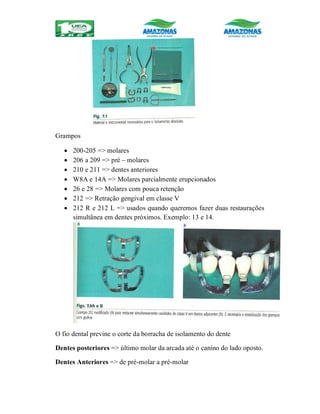 Grampos
 200-205 => molares
 206 a 209 => pré – molares
 210 e 211 => dentes anteriores
 W8A e 14A => Molares parcialmente erupcionados
 26 e 28 => Molares com pouca retenção
 212 => Retração gengival em classe V
 212 R e 212 L => usados quando queremos fazer duas restaurações
simultânea em dentes próximos. Exemplo: 13 e 14.
O fio dental previne o corte da borracha de isolamento do dente
Dentes posteriores => último molar da arcada até o canino do lado oposto.
Dentes Anteriores => de pré-molar a pré-molar
 