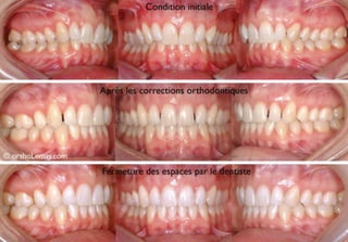 Dents étroites élargies orthodontie