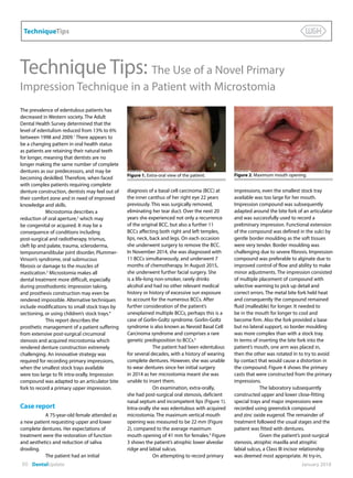 TechniqueTips
80 DentalUpdate	 January 2018
Technique Tips: The Use of a Novel Primary
Impression Technique in a Patient with Microstomia
The prevalence of edentulous patients has
decreased in Western society. The Adult
Dental Health Survey determined that the
level of edentulism reduced from 13% to 6%
between 1998 and 2009.1
There appears to
be a changing pattern in oral health status
as patients are retaining their natural teeth
for longer, meaning that dentists are no
longer making the same number of complete
dentures as our predecessors, and may be
becoming deskilled. Therefore, when faced
with complex patients requiring complete
denture construction, dentists may feel out of
their comfort zone and in need of improved
knowledge and skills.
Microstomia describes a
reduction of oral aperture,2
which may
be congenital or acquired. It may be a
consequence of conditions including
post-surgical and radiotherapy, trismus,
cleft lip and palate, trauma, scleroderma,
temporomandibular joint disorder, Plummer-
Vinson’s syndrome, oral submucous
fibrosis or damage to the muscles of
mastication.3
Microstomia makes all
dental treatment more difficult, especially
during prosthodontic impression taking,
and prosthesis construction may even be
rendered impossible. Alternative techniques
include modifications to small stock trays by
sectioning, or using children’s stock trays.4
This report describes the
prosthetic management of a patient suffering
from extensive post-surgical circumoral
stenosis and acquired microstomia which
rendered denture construction extremely
challenging. An innovative strategy was
required for recording primary impressions,
when the smallest stock trays available
were too large to fit intra-orally. Impression
compound was adapted to an articulator bite
fork to record a primary upper impression.
Case report
A 75-year-old female attended as
a new patient requesting upper and lower
complete dentures. Her expectations of
treatment were the restoration of function
and aesthetics and reduction of saliva
drooling.
The patient had an initial
diagnosis of a basal cell carcinoma (BCC) at
the inner canthus of her right eye 22 years
previously. This was surgically removed,
eliminating her tear duct. Over the next 20
years she experienced not only a recurrence
of the original BCC, but also a further 11
BCCs affecting both right and left temples,
lips, neck, back and legs. On each occasion
she underwent surgery to remove the BCC.
In November 2014, she was diagnosed with
11 BCCs simultaneously, and underwent 7
months of chemotherapy. In August 2015,
she underwent further facial surgery. She
is a life-long non-smoker, rarely drinks
alcohol and had no other relevant medical
history or history of excessive sun exposure
to account for the numerous BCCs. After
further consideration of the patient’s
unexplained multiple BCCs, perhaps this is a
case of Gorlin-Goltz syndrome. Gorlin-Goltz
syndrome is also known as Nevoid Basal Cell
Carcinoma syndrome and comprises a rare
genetic predisposition to BCCs.5
The patient had been edentulous
for several decades, with a history of wearing
complete dentures. However, she was unable
to wear dentures since her initial surgery
in 2014 as her microstomia meant she was
unable to insert them.
On examination, extra-orally,
she had post-surgical oral stenosis, deficient
nasal septum and incompetent lips (Figure 1).
Intra-orally she was edentulous with acquired
microstomia. The maximum vertical mouth
opening was measured to be 22 mm (Figure
2), compared to the average maximum
mouth opening of 41 mm for females.4
Figure
3 shows the patient’s atrophic lower alveolar
ridge and labial sulcus.
On attempting to record primary
impressions, even the smallest stock tray
available was too large for her mouth.
Impression compound was subsequently
adapted around the bite fork of an articulator
and was successfully used to record a
preliminary impression. Functional extension
of the compound was defined in the sulci by
gentle border moulding as the soft tissues
were very tender. Border moulding was
challenging due to severe fibrosis. Impression
compound was preferable to alginate due to
improved control of flow and ability to make
minor adjustments. The impression consisted
of multiple placement of compound with
selective warming to pick up detail and
correct errors. The metal bite fork held heat
and consequently the compound remained
fluid (malleable) for longer. It needed to
be in the mouth for longer to cool and
become firm. Also the fork provided a base
but no lateral support, so border moulding
was more complex than with a stock tray.
In terms of inserting the bite fork into the
patient’s mouth, one arm was placed in,
then the other was rotated in to try to avoid
lip contact that would cause a distortion in
the compound. Figure 4 shows the primary
casts that were constructed from the primary
impressions.
The laboratory subsequently
constructed upper and lower close-fitting
special trays and major impressions were
recorded using greenstick compound
and zinc oxide eugenol. The remainder of
treatment followed the usual stages and the
patient was fitted with dentures.
Given the patient’s post-surgical
stenosis, atrophic maxilla and atrophic
labial sulcus, a Class III incisor relationship
was deemed most appropriate. At try-in,
Figure 1. Extra-oral view of the patient. Figure 2. Maximum mouth opening.
 