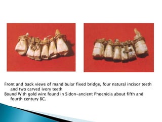 Front and back views of mandibular fixed bridge, four natural incisor teeth
   and two carved ivory teeth
Bound With gold wire found in Sidon-ancient Phoenicia about fifth and
   fourth century BC.
 