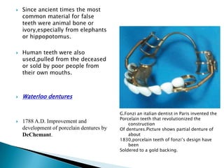    Since ancient times the most
    common material for false
    teeth were animal bone or
    ivory,especially from elephants
    or hippopotomus.

   Human teeth were also
    used,pulled from the deceased
    or sold by poor people from
    their own mouths.



   Waterloo dentures

                                           G.Fonzi an italian dentist in Paris invented the
                                           Porcelain teeth that revolutionized the
   1788 A.D. Improvement and                  construction
    development of porcelain dentures by   Of dentures.Picture shows partial denture of
    DeChemant.                                 about
                                           1830,porcelain teeth of fonzi’s design have
                                               been
                                           Soldered to a gold backing.
 