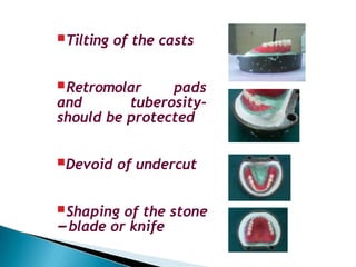 Tilting of the casts
Retromolar pads
and tuberosity-
should be protected
Devoid of undercut
Shaping of the stone
–blade or knife
 
