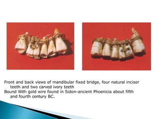 Front and back views of mandibular fixed bridge, four natural incisor
teeth and two carved ivory teeth
Bound With gold wire found in Sidon-ancient Phoenicia about fifth
and fourth century BC.
 