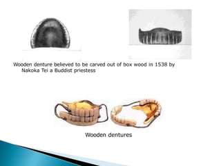 Wooden denture believed to be carved out of box wood in 1538 by
Nakoka Tei a Buddist priestess
Wooden dentures
 