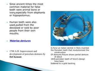 🞂​ Since ancient times the most
common material for false
teeth were animal bone or
ivory,especially from elephants
or hippopotomus.
🞂​ Human teeth were also
used,pulled from the
deceased or sold by poor
people from their own
mouths.
🞂​ Waterloo dentures
🞂​ 1788 A.D. Improvement and
development of porcelain dentures by
DeChemant.
G.Fonzi an italian dentist in Paris invented
the Porcelain teeth that revolutionized the
construction
Of dentures.Picture shows partial denture
of about
1830,porcelain teeth of fonzi’s design
have been
Soldered to a gold backing.
 