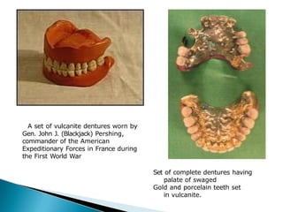 A set of vulcanite dentures worn by
Gen. John J. (Blackjack) Pershing,
commander of the American
Expeditionary Forces in France during
the First World War
Set of complete dentures having
palate of swaged
Gold and porcelain teeth set
in vulcanite.
 