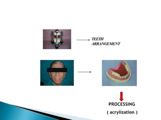 PROCESSING
( acrylization )
TEETH
ARRANGEMENT
 