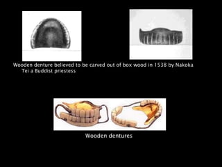 Wooden denture believed to be carved out of box wood in 1538 by Nakoka
Tei a Buddist priestess
Wooden dentures
 