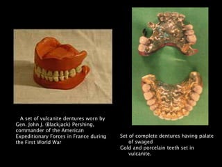 A set of vulcanite dentures worn by
Gen. John J. (Blackjack) Pershing,
commander of the American
Expeditionary Forces in France during
the First World War
Set of complete dentures having palate
of swaged
Gold and porcelain teeth set in
vulcanite.
 