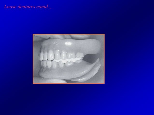 Denture complaints (1).ppt | Dental Health | Diseases and Conditions