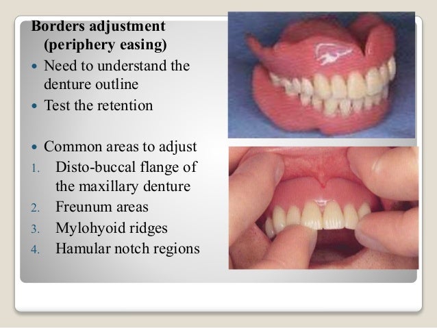 Before Delivering Finished Dentures