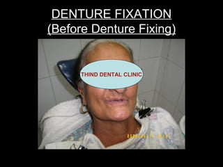 DENTURE FIXATION
(Before Denture Fixing)


      THIND DENTAL CLINIC
 