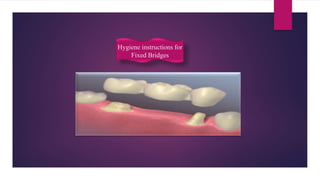Hygiene instructions for
Fixed Bridges
 