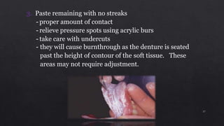3. Paste remaining with no streaks
- proper amount of contact
- relieve pressure spots using acrylic burs
- take care with undercuts
- they will cause burnthrough as the denture is seated
past the height of contour of the soft tissue. These
areas may not require adjustment.
17
 
