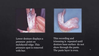 Lower denture displays a
pressure point on
mylohyoid ridge. This
pressure spot is removed
with bur.
This recording and
trimming is repeated until
denture base surface do not
show through the paste.
The paste layer is even. 18
 