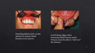 Checking labial notch- as the
denture is seated, labial
frenum is too narrow.
Avoid sharp edges when
trimming labial frenum notch.
Frenum must be able to “roll over”
the denture.
27
 