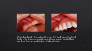 If stretched cheek is released, buccal frenum will lie tightly against functional
border of the denture. As mouth is opened, buccal frena are stretched back
and down. So, frena contribute to a well adapted border.
28
 