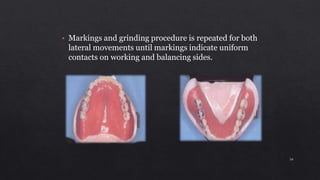 • Markings and grinding procedure is repeated for both
lateral movements until markings indicate uniform
contacts on working and balancing sides.
34
 