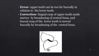 • Error- upper teeth can be too far buccally in
relation to the lower teeth.
• Correction- lingual cusp of upper tooth made
narrow by broadening of central fossa, and
buccal cusp of the lower tooth is moved
buccally by broadening of the central fossa.
45
 