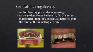 • central-bearing pin works on a spring.
• As the patient closes his mouth, the pin in the
mandibular mounting contacts a metal plate in
the vault of the maxillary denture.
47
 