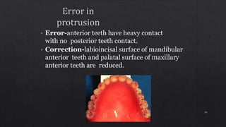 • Error-anterior teeth have heavy contact
with no posterior teeth contact.
• Correction-labioincisal surface of mandibular
anterior teeth and palatal surface of maxillary
anterior teeth are reduced.
59
 