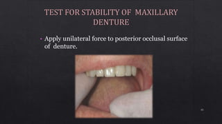 • Apply unilateral force to posterior occlusal surface
of denture.
65
 