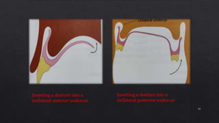 Inserting a denture into a
unilateral anterior undercut
Inserting a denture into a
unilateral posterior undercut
82
 