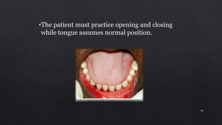 •The patient must practice opening and closing
while tongue assumes normal position.
86
 
