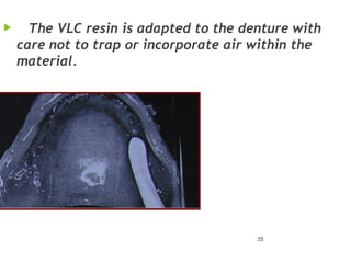 35
 The VLC resin is adapted to the denture with
care not to trap or incorporate air within the
material.
 