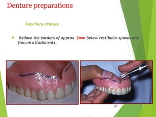 Denture preparations
Maxillary denture
 Reduce the borders of approx 2mm below vestibular spaces and
frenum attachments.
62
 