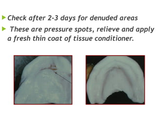  Check after 2-3 days for denuded areas
 These are pressure spots, relieve and apply
a fresh thin coat of tissue conditioner.
 