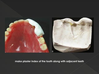 DENTURE REPAIR in Complete dentures Dr Sanket Jadhav | PPTX