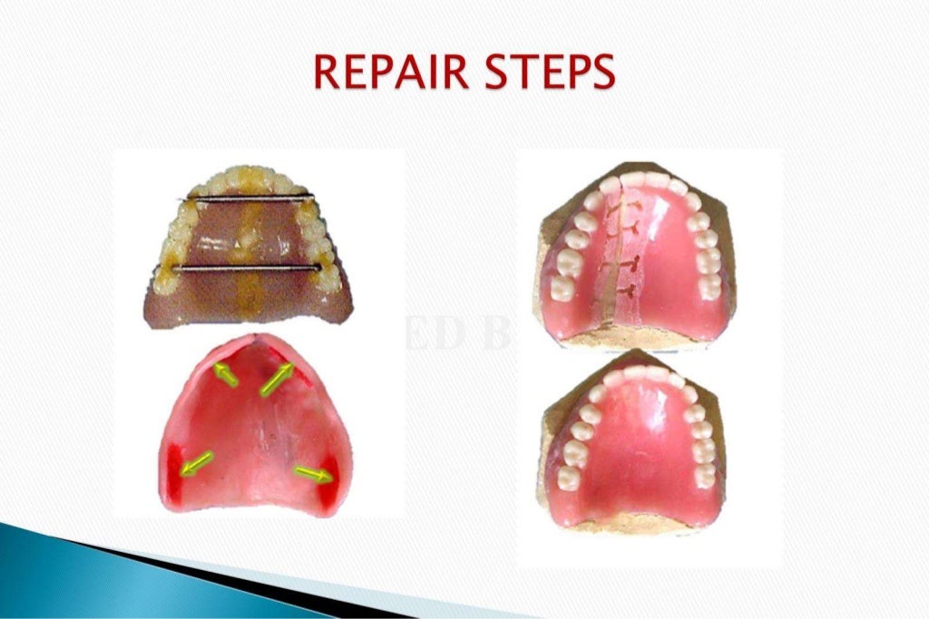 Denture repair part 1
