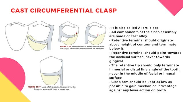 DENTURES - CLASSIFICATION OF PARTIALLY EDENTULOUS ARCHES - CLASPS.pdf ...