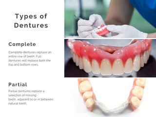 Dentures: Frequently Asked Questions | PDF