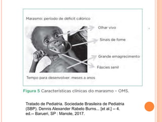 Tratado de Pediatria. Sociedade Brasileira de Pediatria
(SBP). Dennis Alexander Rabelo Burns... [et al.] -- 4.
ed.-- Barueri, SP : Manole, 2017.
 