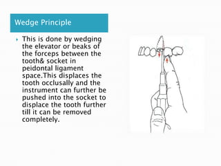 Wedge Principle
 This is done by wedging
the elevator or beaks of
the forceps between the
tooth& socket in
peidontal ligament
space.This displaces the
tooth occlusally and the
instrument can further be
pushed into the socket to
displace the tooth further
till it can be removed
completely.
 